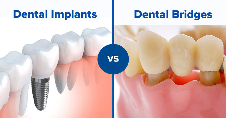 Dental Bridges Vs Dental Implants Extreme Dentistry 